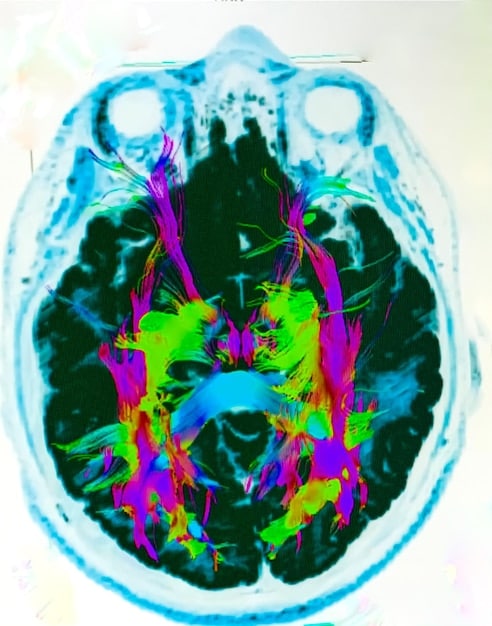 A brain scan illustrating the release of endorphins during an act of kindness, with highlighted areas showing activation in pleasure centers.